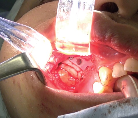 koplight retractor for oral surgery