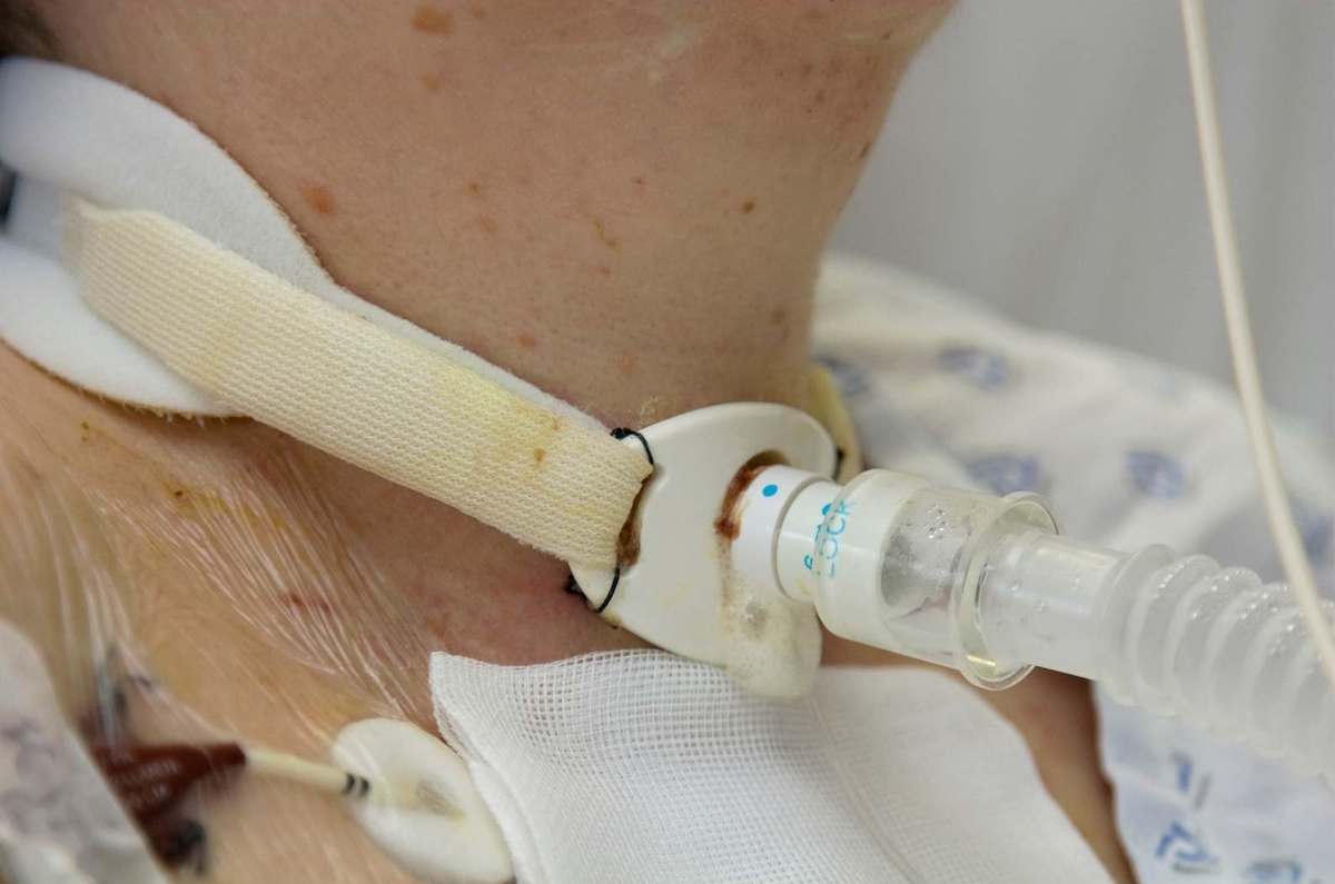 Tracheotomy What Retractors Are Used? Yasui Co., Ltd.