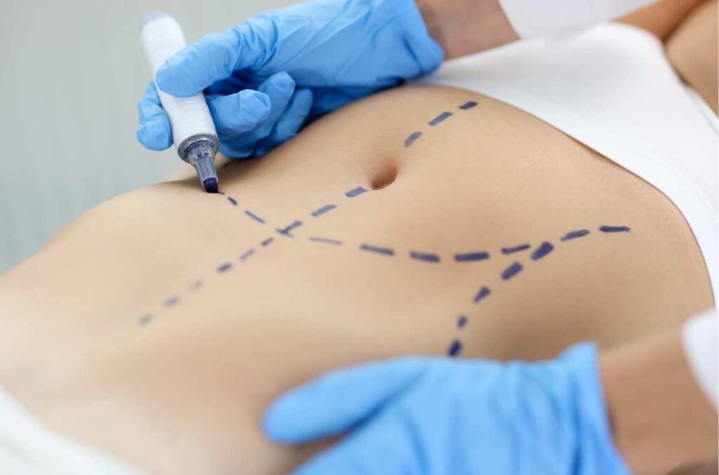 skin marking before surgery, abdominal