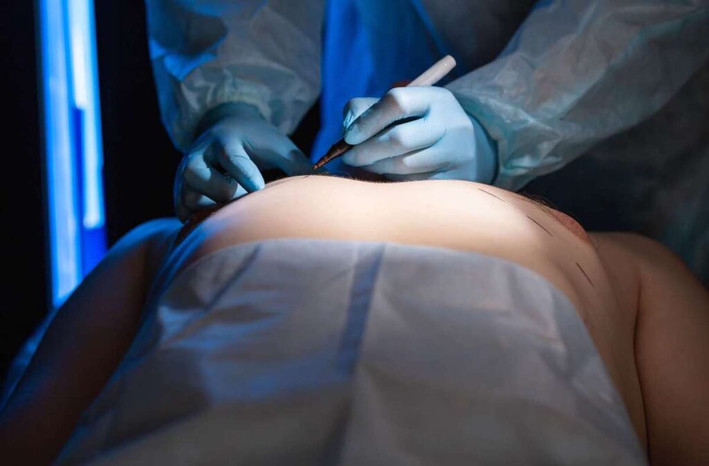 surgeon marking skin during breast reduction surgery