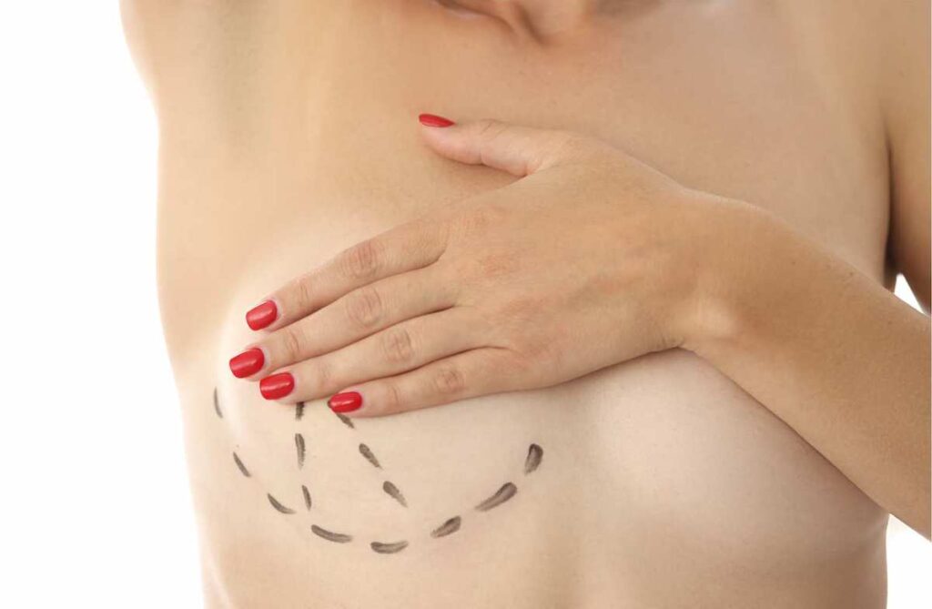 pre-operative surgical marking, drawing on the skin, for breast augmentation