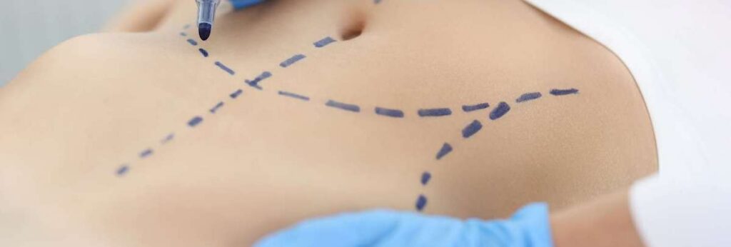 skin markers mark where the surgeon will operate